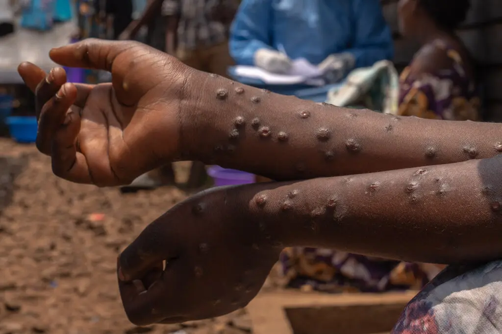 MPOX à Kaziba : Cet appel à une riposte sanitaire urgente
