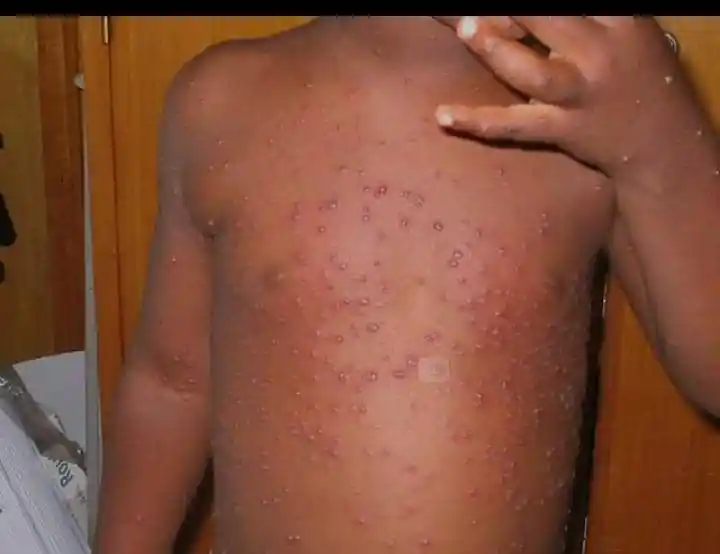 Idjwi/Sud-Kivu : Alerte sanitaire après plusieurs cas de rougeole