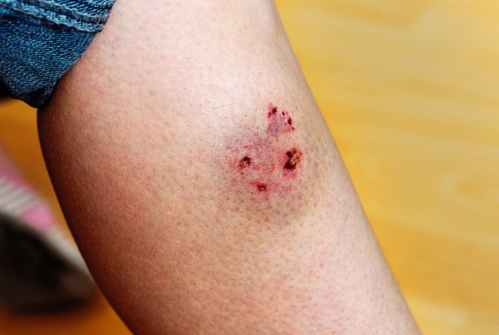 Nyamugari/Uvira : Après des attaques de chiens, l’urgence sanitaire ignorée