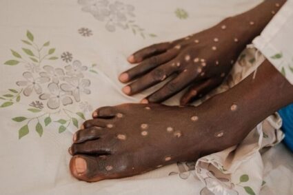 Mwenga : 25 cas suspects de mpox signalés à Itombwe